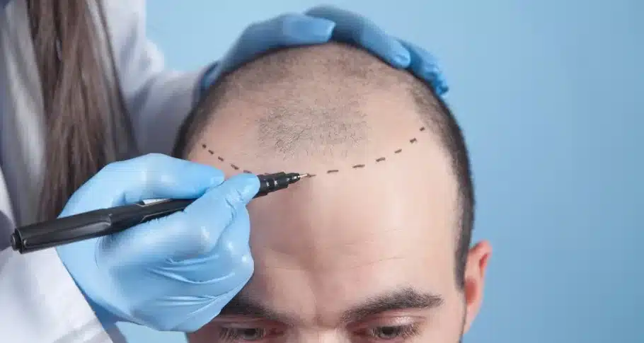 marketing-for-hair-transplant-clinic
